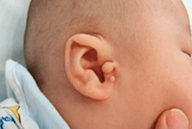 Preauricular Tags Removal საქართველო